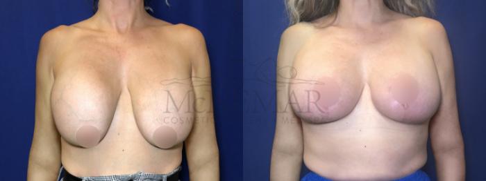 Breast Lift (Mastopexy) Case 207 Before & After Front | Tracy, Brentwood & Livermore, CA | McNemar Cosmetic Surgery