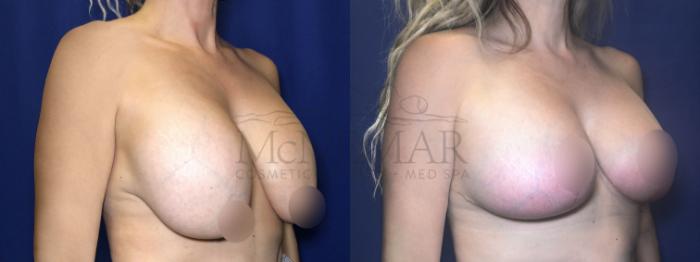 Breast Lift (Mastopexy) Case 207 Before & After Left Side | Tracy, Brentwood & Livermore, CA | McNemar Cosmetic Surgery