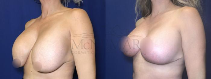 Breast Lift (Mastopexy) Case 207 Before & After Right Side | Tracy, Brentwood & Livermore, CA | McNemar Cosmetic Surgery