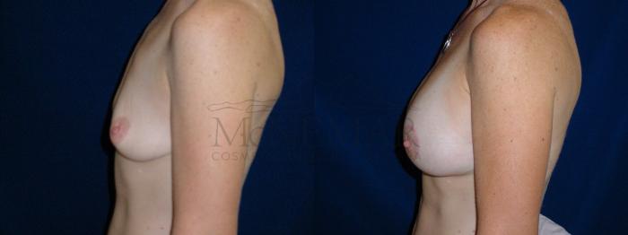Breast Lift (Mastopexy) Case 26 Before & After View #1 | Tracy, Brentwood & Livermore, CA | McNemar Cosmetic Surgery