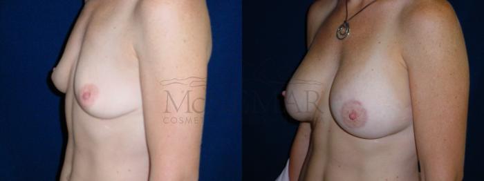 Breast Lift (Mastopexy) Case 26 Before & After View #2 | Tracy, Brentwood & Livermore, CA | McNemar Cosmetic Surgery