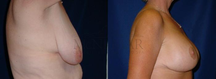Breast Lift (Mastopexy) Case 34 Before & After View #2 | San Ramon & Tracy, CA | McNemar Cosmetic Surgery