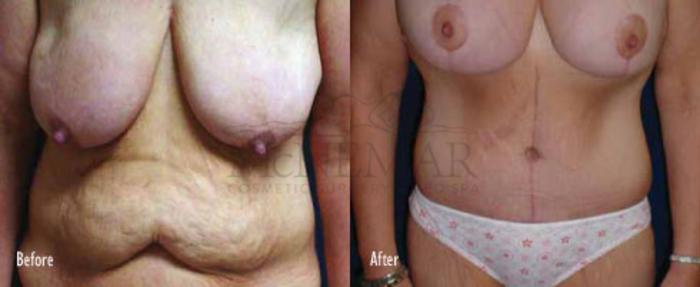 Breast Lift (Mastopexy) Case 40 Before & After View #1 | Tracy, Brentwood & Livermore, CA | McNemar Cosmetic Surgery