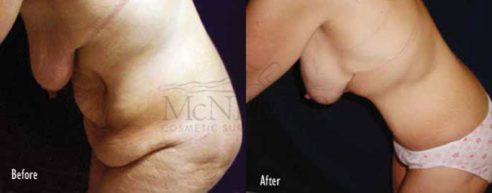 Breast Lift (Mastopexy) Case 40 Before & After View #2 | San Ramon & Tracy, CA | McNemar Cosmetic Surgery