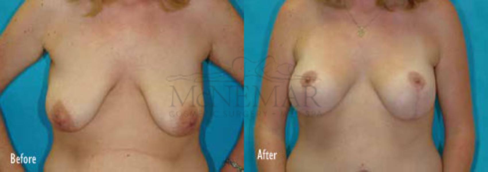 Breast Lift (Mastopexy) Case 41 Before & After View #1 | Tracy, Brentwood & Livermore, CA | McNemar Cosmetic Surgery