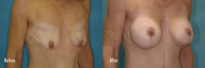 Breast Lift (Mastopexy) Case 42 Before & After View #1 | San Ramon & Tracy, CA | McNemar Cosmetic Surgery