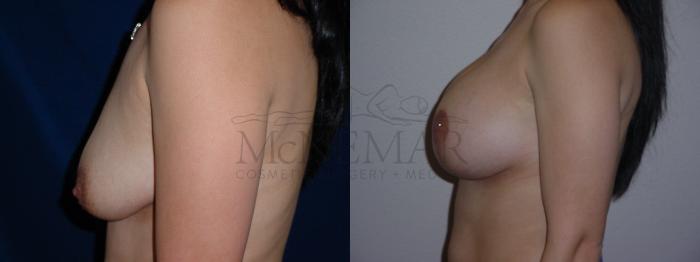 Breast Lift (Mastopexy) Case 61 Before & After View #2 | Tracy, Brentwood & Livermore, CA | McNemar Cosmetic Surgery
