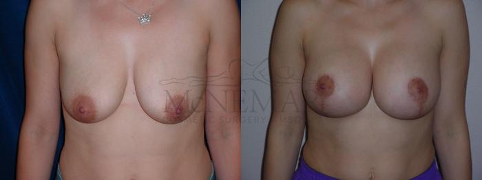 Breast Lift (Mastopexy) Case 61 Before & After View #3 | Tracy, Brentwood & Livermore, CA | McNemar Cosmetic Surgery
