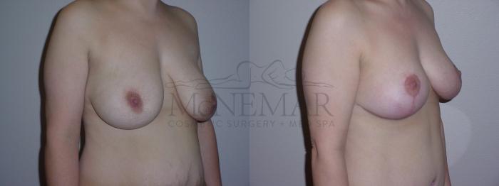 Breast Lift (Mastopexy) Case 72 Before & After View #1 | San Ramon & Tracy, CA | McNemar Cosmetic Surgery