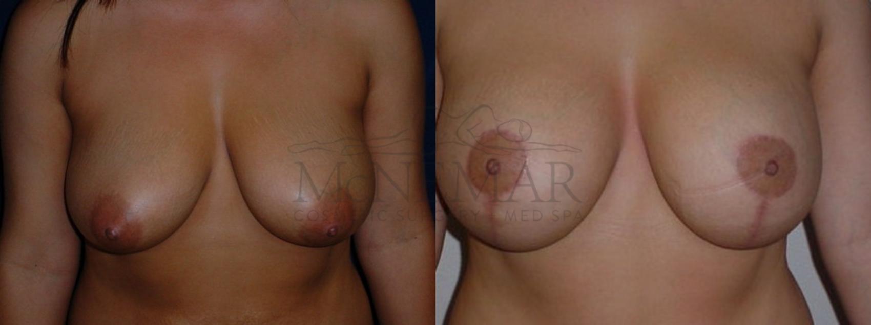 Breast Lift (Mastopexy) Case 79 Before & After View #1 | San Ramon & Tracy, CA | McNemar Cosmetic Surgery