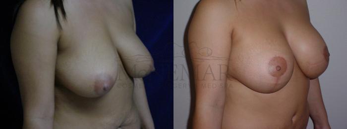 Breast Lift (Mastopexy) Case 79 Before & After View #2 | San Ramon & Tracy, CA | McNemar Cosmetic Surgery