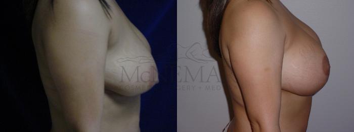 Breast Lift (Mastopexy) Case 79 Before & After View #3 | San Ramon & Tracy, CA | McNemar Cosmetic Surgery