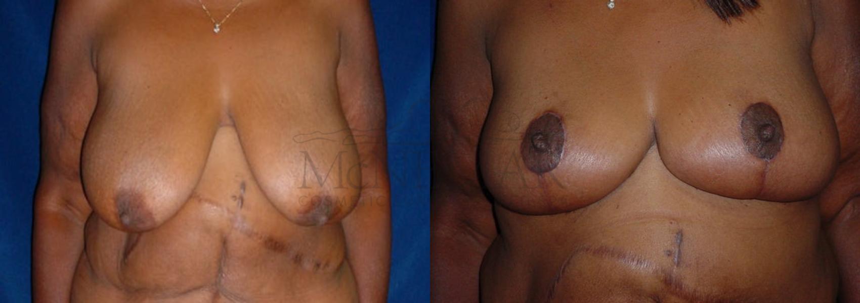 Breast Lift (Mastopexy) Case 86 Before & After View #1 | Tracy, Brentwood & Livermore, CA | McNemar Cosmetic Surgery