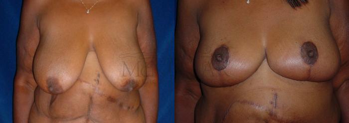 Breast Lift (Mastopexy) Case 86 Before & After View #1 | San Ramon & Tracy, CA | McNemar Cosmetic Surgery