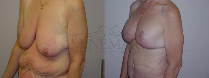 Breast Lift (Mastopexy) Case 89 Before & After View #2 | San Ramon & Tracy, CA | McNemar Cosmetic Surgery