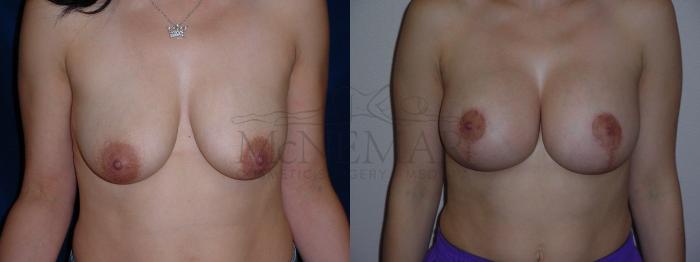 Breast Lift (Mastopexy) Case 95 Before & After View #1 | Tracy, Brentwood & Livermore, CA | McNemar Cosmetic Surgery