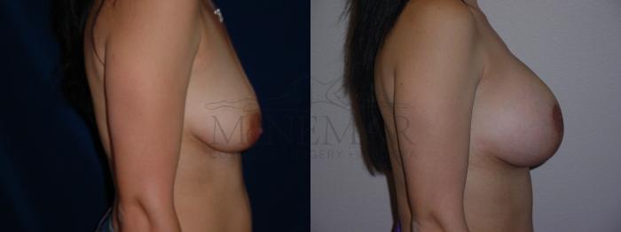 Breast Lift (Mastopexy) Case 95 Before & After View #2 | Tracy, Brentwood & Livermore, CA | McNemar Cosmetic Surgery