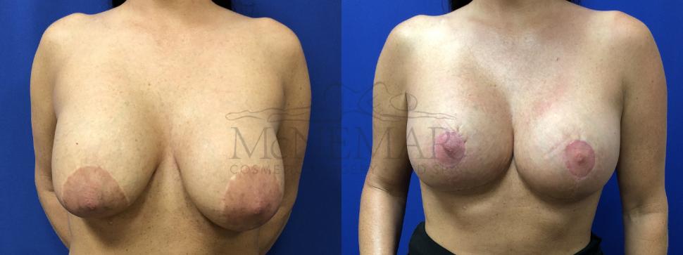 Breast Lift with Augmentation Case 141 Before & After Front | Tracy, Brentwood & Livermore, CA | McNemar Cosmetic Surgery