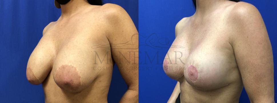 Breast Augmentation Case 141 Before & After Right Oblique | San Ramon & Tracy, CA | McNemar Cosmetic Surgery