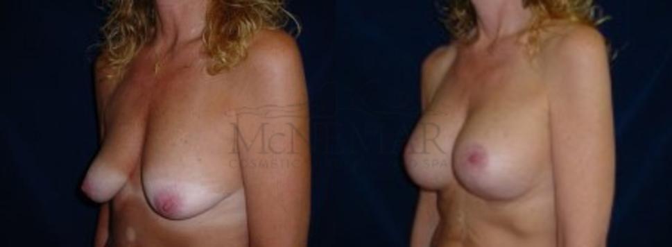 Breast Lift with Augmentation Case 15 Before & After View #1 | San Ramon & Tracy, CA | McNemar Cosmetic Surgery