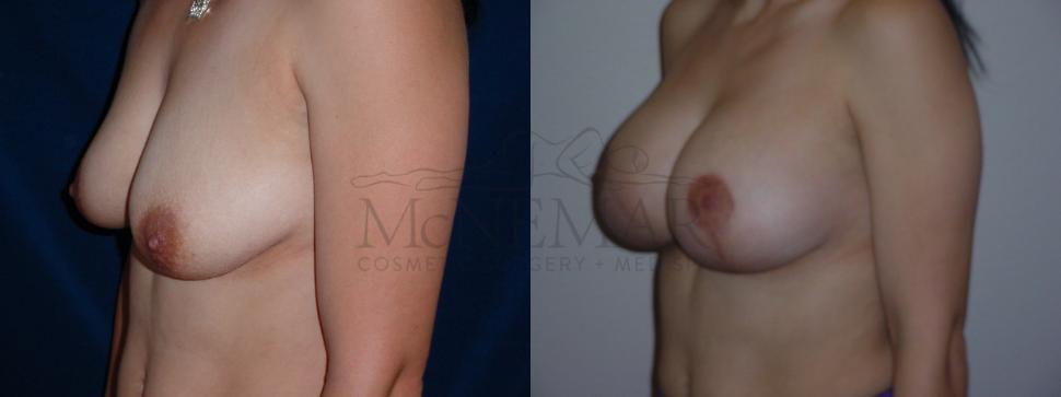 Breast Lift with Augmentation Case 61 Before & After View #1 | Tracy, Brentwood & Livermore, CA | McNemar Cosmetic Surgery