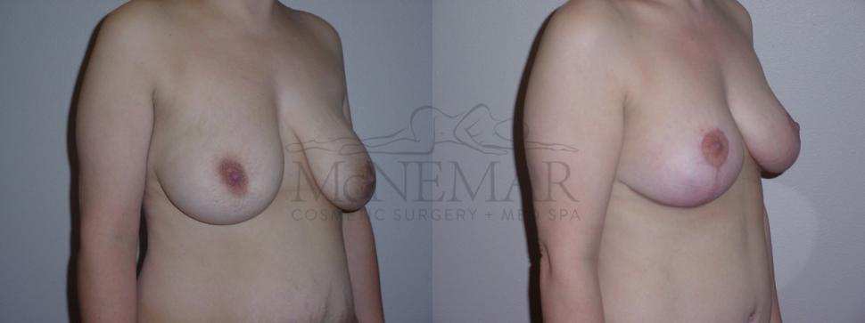 Breast Lift with Augmentation Case 72 Before & After View #1 | San Ramon & Tracy, CA | McNemar Cosmetic Surgery