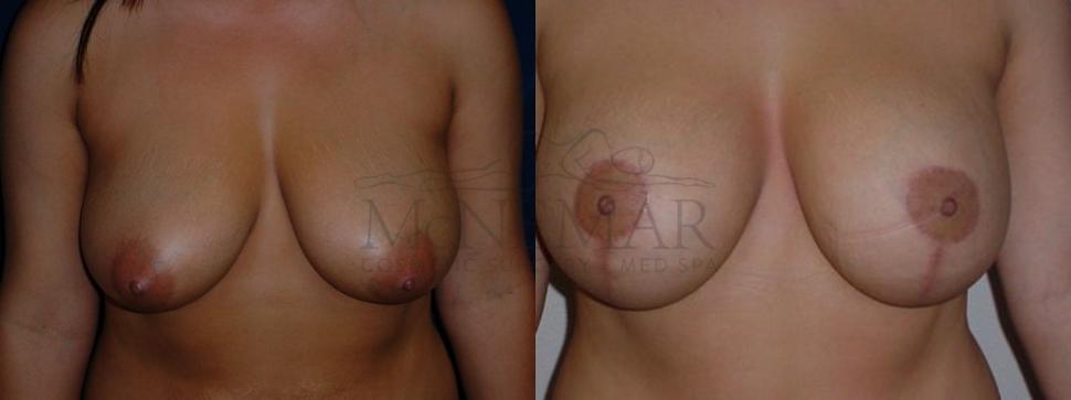 Breast Lift with Augmentation Case 79 Before & After View #1 | Tracy, Brentwood & Livermore, CA | McNemar Cosmetic Surgery