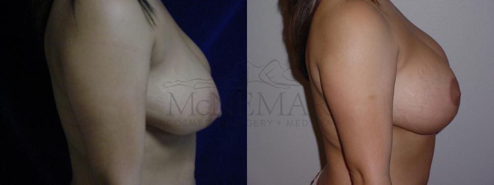 Breast Lift with Augmentation Case 79 Before & After View #3 | San Ramon & Tracy, CA | McNemar Cosmetic Surgery
