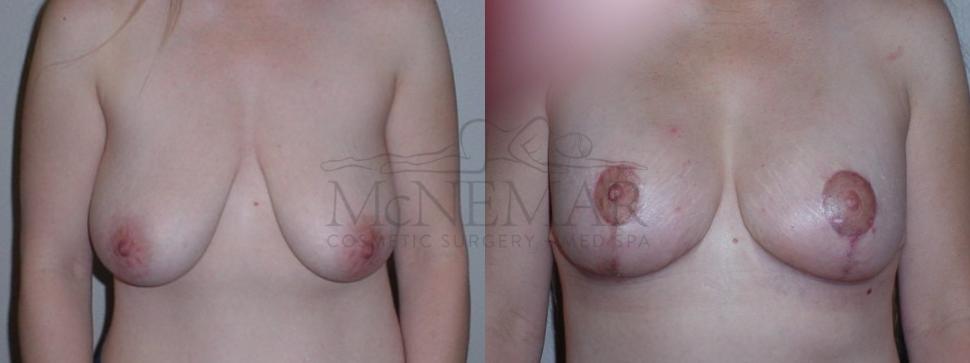 Breast Lift with Augmentation Case 87 Before & After View #1 | Tracy, Brentwood & Livermore, CA | McNemar Cosmetic Surgery