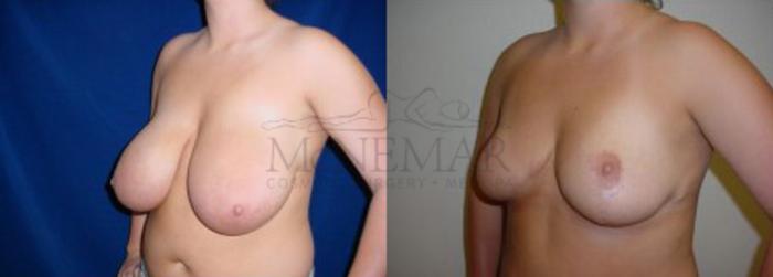Breast Reduction Case 10 Before & After View #2 | Tracy, Brentwood & Livermore, CA | McNemar Cosmetic Surgery