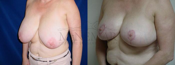 Breast Reduction Case 29 Before & After View #1 | Tracy, Brentwood & Livermore, CA | McNemar Cosmetic Surgery