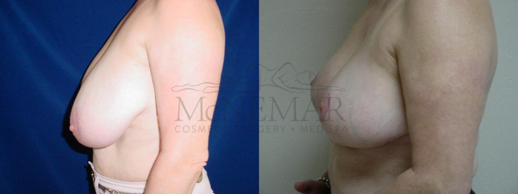 Breast Reduction Case 29 Before & After View #2 | San Ramon & Tracy, CA | McNemar Cosmetic Surgery