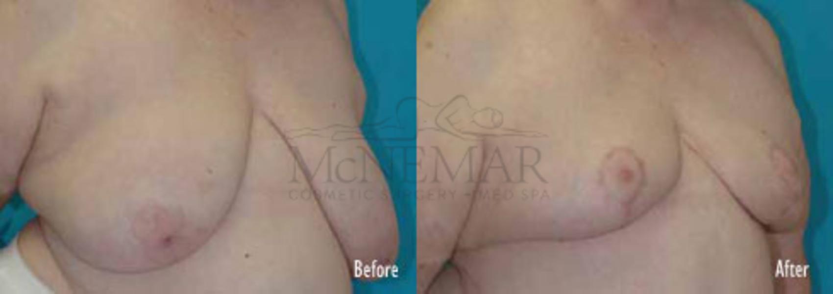Breast Reduction Case 44 Before & After View #1 | San Ramon & Tracy, CA | McNemar Cosmetic Surgery