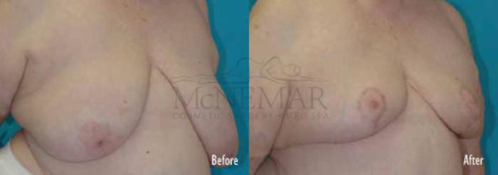 Breast Reduction Case 44 Before & After View #1 | Tracy, Brentwood & Livermore, CA | McNemar Cosmetic Surgery