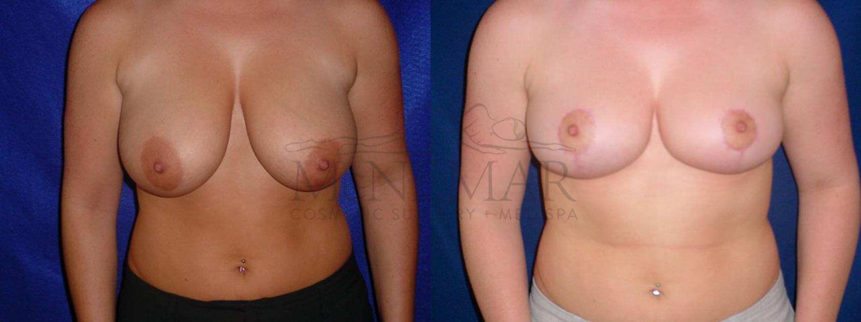 Breast Reduction Case 57 Before & After View #1 | San Ramon & Tracy, CA | McNemar Cosmetic Surgery