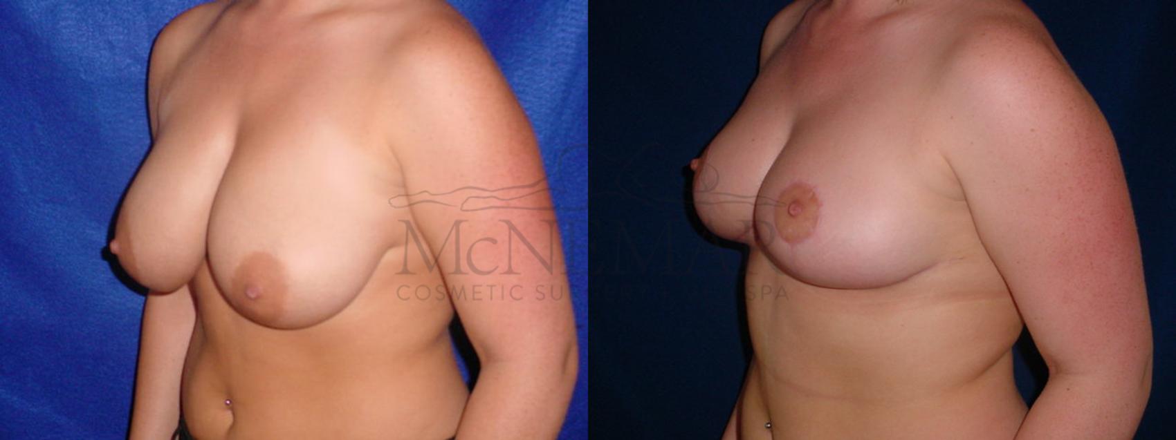 Breast Reduction Case 57 Before & After View #2 | San Ramon & Tracy, CA | McNemar Cosmetic Surgery
