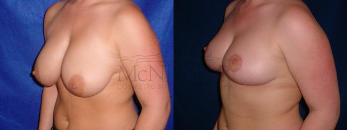 Breast Reduction Case 57 Before & After View #2 | Tracy, Brentwood & Livermore, CA | McNemar Cosmetic Surgery
