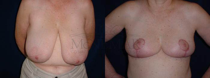 Breast Reduction Case 58 Before & After View #1 | Tracy, Brentwood & Livermore, CA | McNemar Cosmetic Surgery