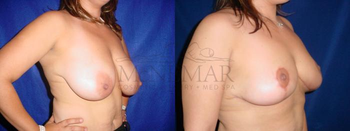 Breast Reduction Case 60 Before & After View #2 | Tracy, Brentwood & Livermore, CA | McNemar Cosmetic Surgery