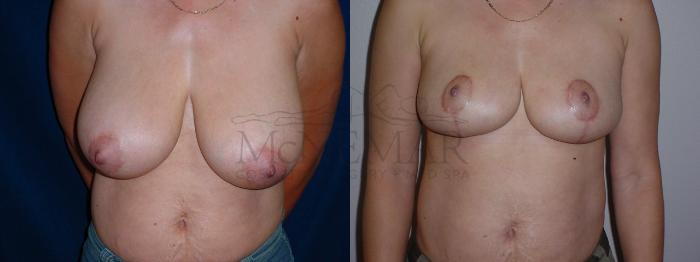 Breast Reduction Case 67 Before & After View #1 | Tracy, Brentwood & Livermore, CA | McNemar Cosmetic Surgery
