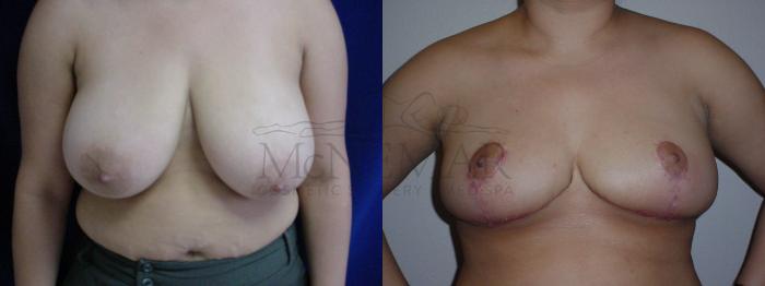 Breast Reduction Case 68 Before & After View #1 | Tracy, Brentwood & Livermore, CA | McNemar Cosmetic Surgery