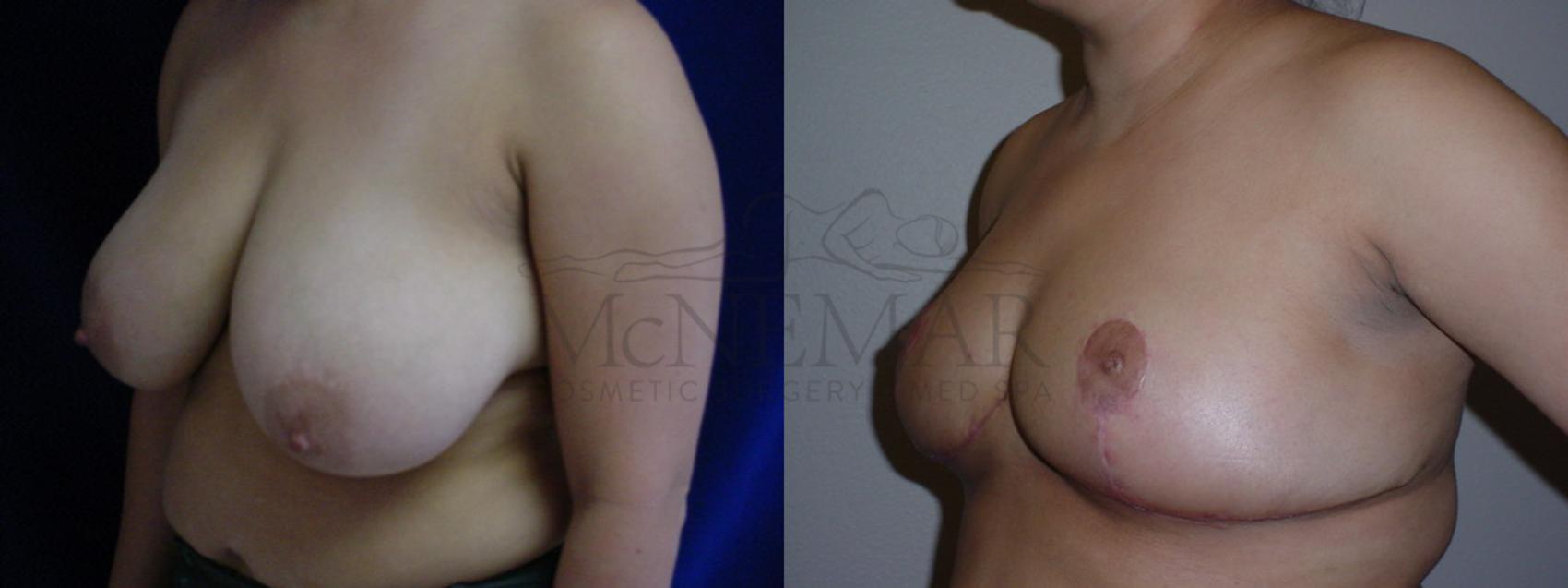 Breast Reduction Case 68 Before & After View #2 | San Ramon & Tracy, CA | McNemar Cosmetic Surgery