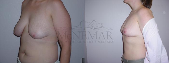 Breast Reduction Case 74 Before & After View #2 | Tracy, Brentwood & Livermore, CA | McNemar Cosmetic Surgery