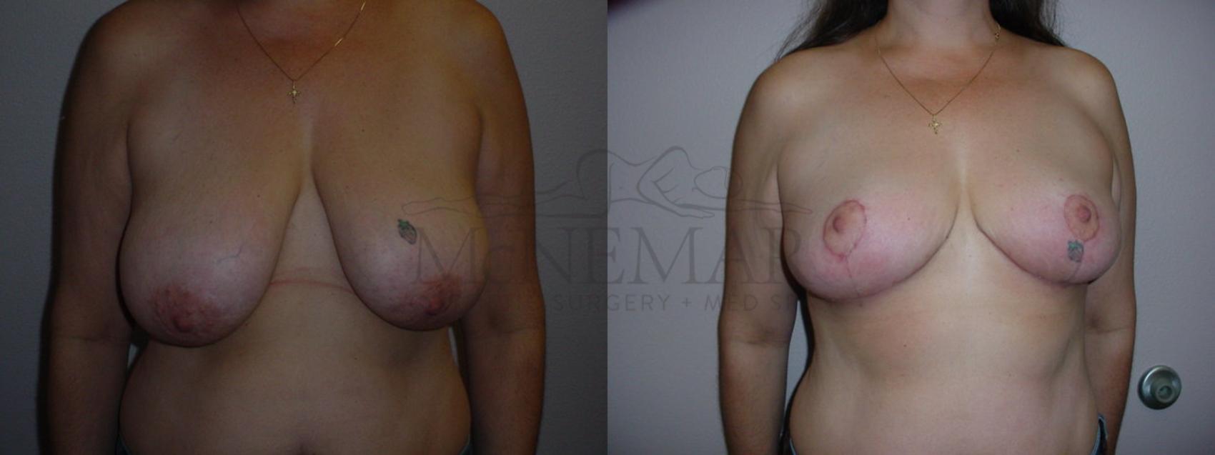 Breast Reduction Case 75 Before & After View #1 | San Ramon & Tracy, CA | McNemar Cosmetic Surgery