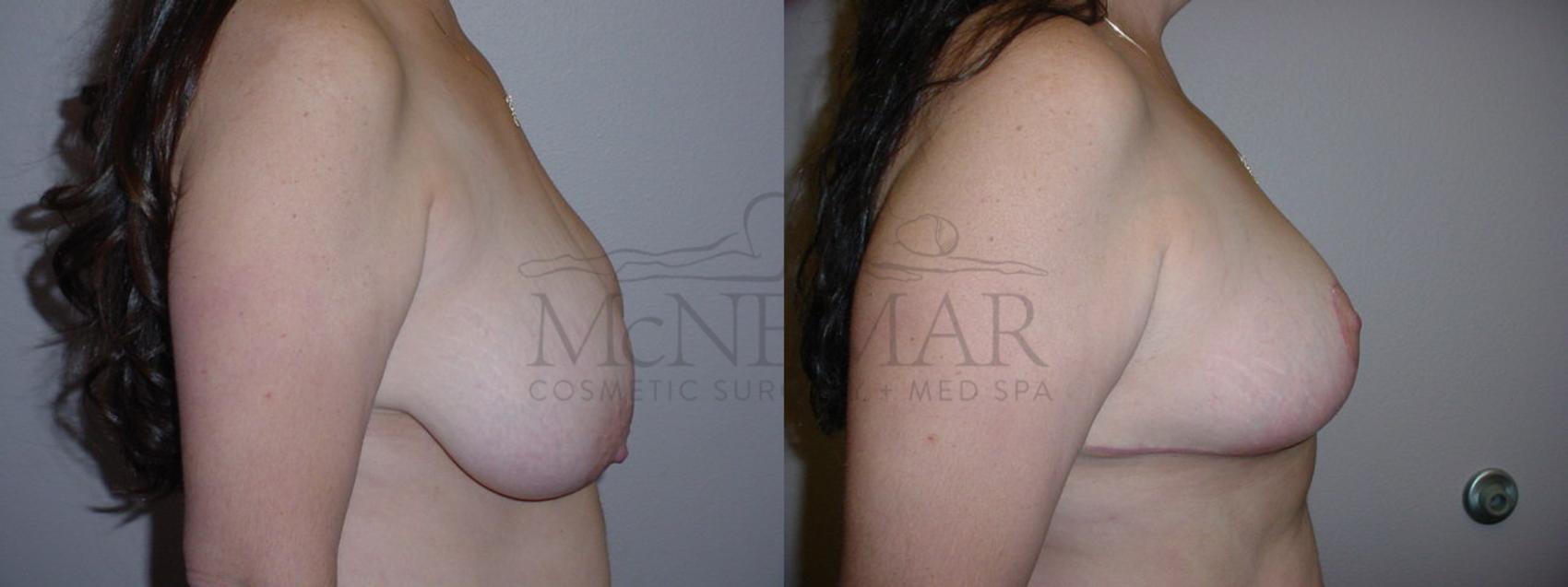 Breast Reduction Case 75 Before & After View #2 | San Ramon & Tracy, CA | McNemar Cosmetic Surgery