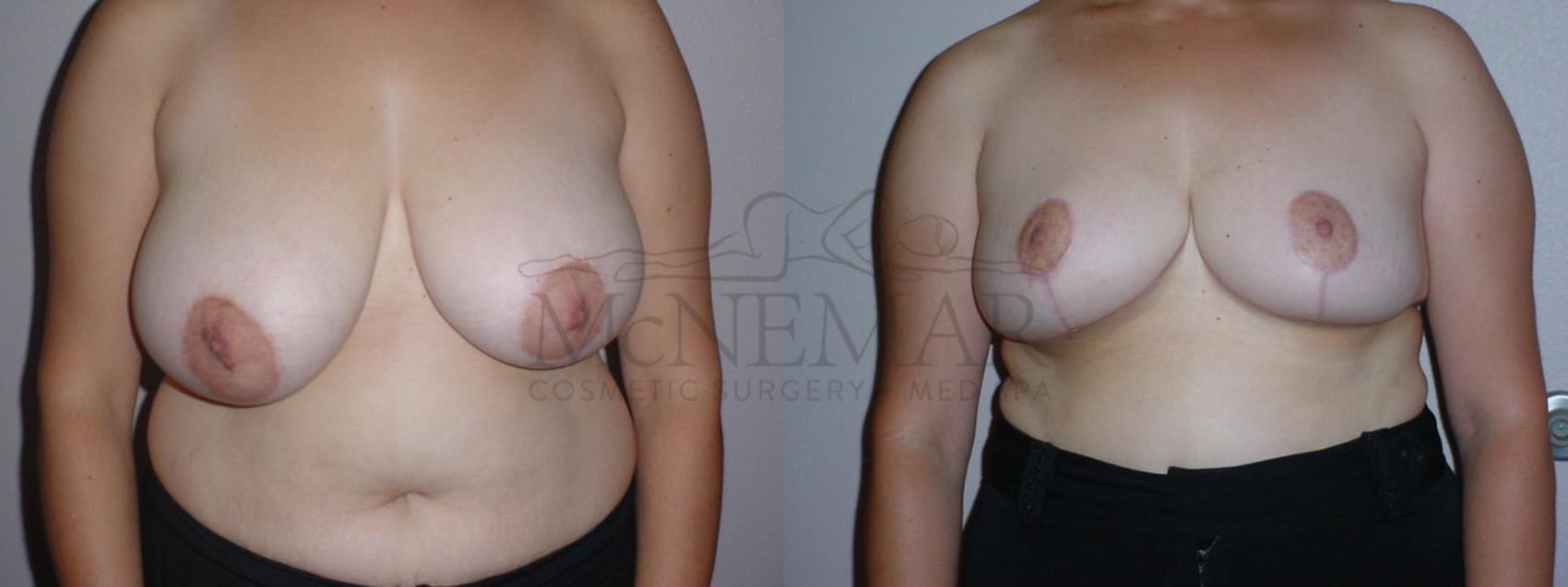 Breast Reduction Case 85 Before & After View #1 | San Ramon & Tracy, CA | McNemar Cosmetic Surgery