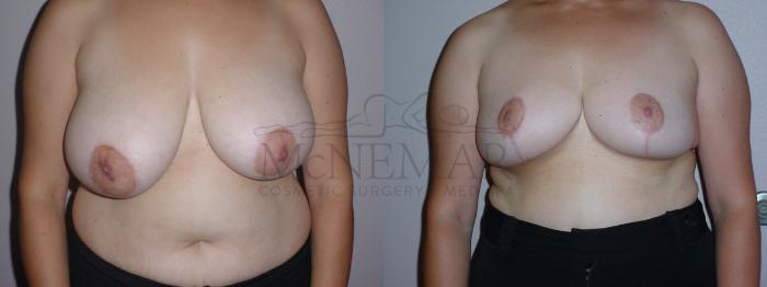 Breast Reduction Case 85 Before & After View #1 | Tracy, Brentwood & Livermore, CA | McNemar Cosmetic Surgery