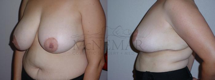 Breast Reduction Case 85 Before & After View #2 | Tracy, Brentwood & Livermore, CA | McNemar Cosmetic Surgery