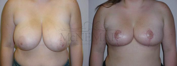 Breast Reduction Case 99 Before & After View #1 | San Ramon & Tracy, CA | McNemar Cosmetic Surgery