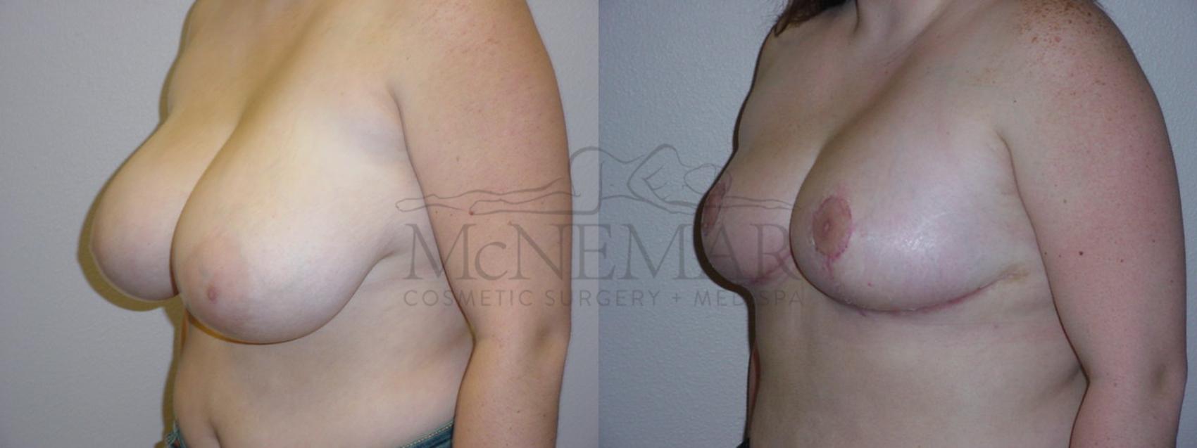 Breast Reduction Case 99 Before & After View #2 | San Ramon & Tracy, CA | McNemar Cosmetic Surgery